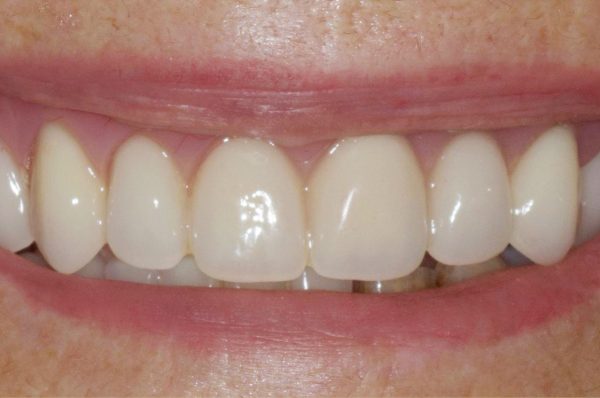 After -Auckland Cosmetic Dental Clinic