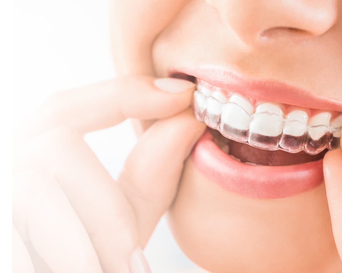 Invisalign
