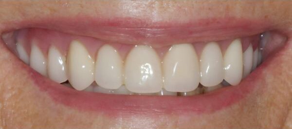 Dentures