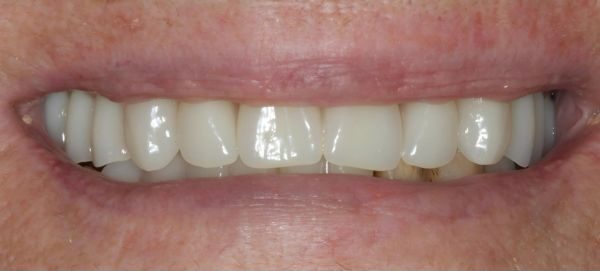 Dentures