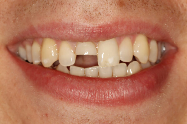 Before - Auckland Cosmetic Dental Clinic